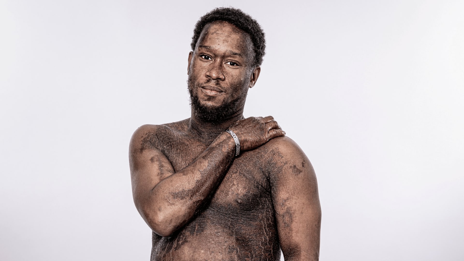 Elliot, who has lamellar ichthyosis, in a studio portrait with one hand resting on his shoulder.